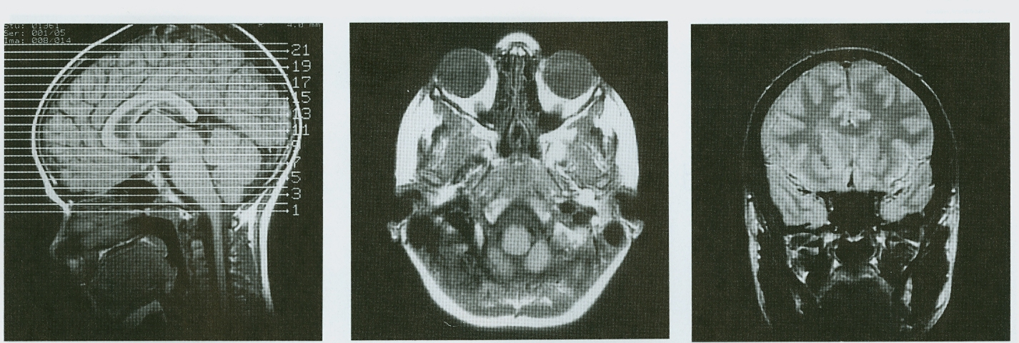 Magnetic resonance imaging of a head